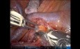 Segmentectomie Robotique S2 Droite pour le Cancer du Poumon Non à Petites Cellules de Stade 1 (VIdéo Non Editée)