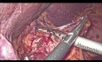 Gastrectomie laparoscopique pour le cancer gastrique distal