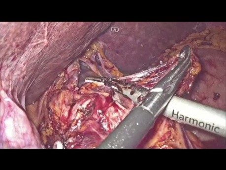 Gastrectomie laparoscopique pour le cancer gastrique distal