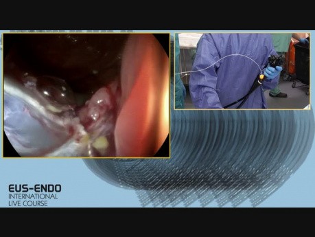 Résection endoscopique d'un polype du cæcum