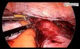 Hystérectomie totale par laparoscopie en raison de l'utérus très volumineux avec plusieurs fibromes