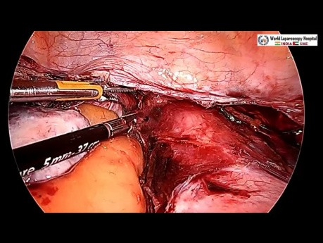Hystérectomie totale par laparoscopie en raison de l'utérus très volumineux avec plusieurs fibromes