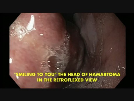 Tumeur mixte mésenchymateuse pédonculée - Hamartome de l'œsophage
