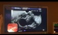 Ulcère gastrique résistant à la provocation diagnostique finalement diagnostiqué comme un lymphome non hodgkinien