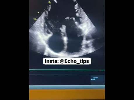 Ventricule Physiologique Unique 