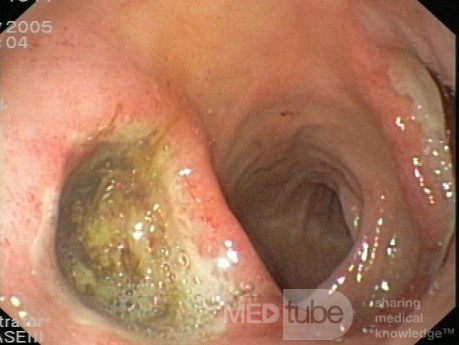 Les ulcères duodénaux " Kissing Ulcers".