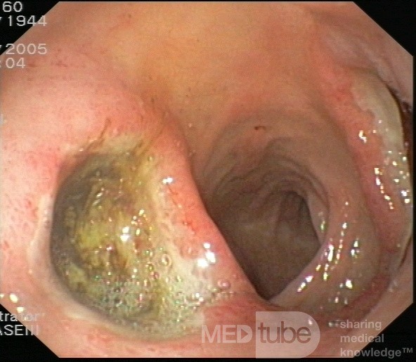 Les ulcères duodénaux " Kissing Ulcers".