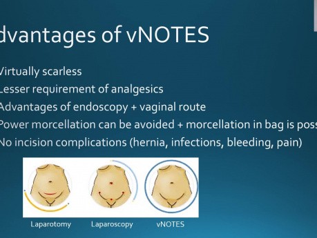 Ablation micro-ondes guidée par laparoscopie et échographie des fibromes - LUMWA vNOTES Myomectomie sans cicatrice