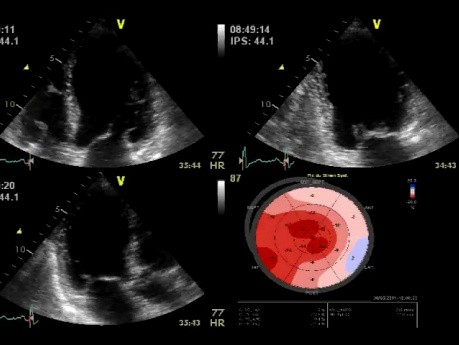 L'évaluation échocardiographique d'une insuffisance mitrale (IM)  - l'échocardiographie de stress sous dobutamine