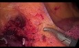Hémicolectomie laparoscopique droite pour cancer du cæcum, excision mésocolique complète (CME)