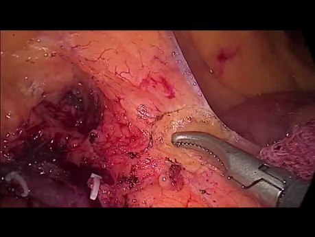 Hémicolectomie laparoscopique droite pour cancer du cæcum, excision mésocolique complète (CME)