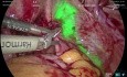 Adénomyomectomie Laparoscopique par Imagerie ICG/NIR