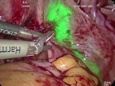 Adénomyomectomie Laparoscopique par Imagerie ICG/NIR