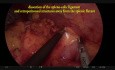 Exérèse totale du mésorectum par coelioscopie avec résection intersphinctérienne du rectum et l'iléostomie