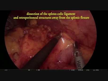 Exérèse totale du mésorectum par coelioscopie avec résection intersphinctérienne du rectum et l'iléostomie