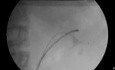 Chirurgie intrarénale rétrograde - Image fluoroscopique