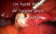 Ovariectomie par laparoscopie en raison d'un kyste ovarien