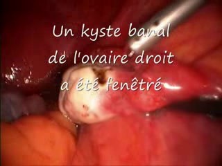 Ovariectomie par laparoscopie en raison d'un kyste ovarien
