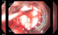 Varices Œsophagiennes en Hémorragie Active – Thérapie de Sauvetage Endoscopique