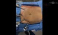 Cholécystectomie Robotisée ICG et CPO ; Variation Aberrante du Canal Postérieur Droit par Rapport au Canal Cystique