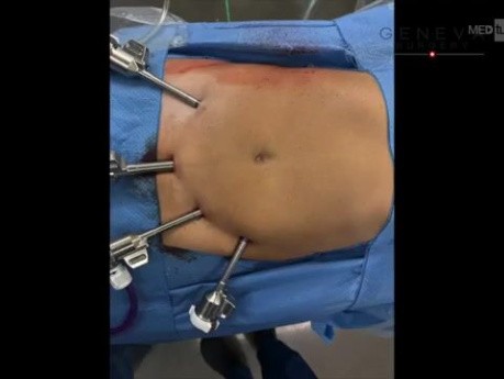 Cholécystectomie Robotisée ICG et CPO ; Variation Aberrante du Canal Postérieur Droit par Rapport au Canal Cystique