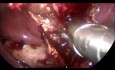 Cholécystite Aigue Lithiasique Laparoscopique