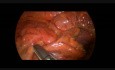Colectomie segmentaire laparoscopique par agrafage chez une adolescente de 16 ans