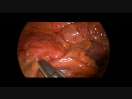 Colectomie segmentaire laparoscopique par agrafage chez une adolescente de 16 ans