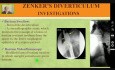 Diverticule de Zenker - Dysphagie