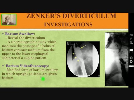 Diverticule de Zenker - Dysphagie