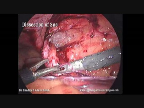 Réparation laparoscopique de la hernie inguinale (TAPP), pas à pas