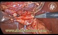 Cholécystectomie laparoscopique: Dissection fine et anatomie