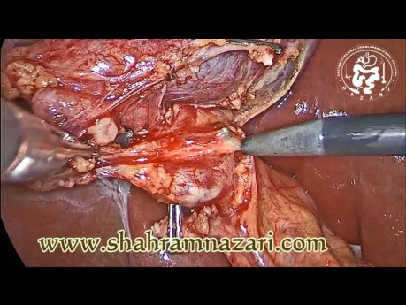 Cholécystectomie laparoscopique: Dissection fine et anatomie
