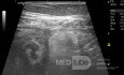 Abcès appendiculaire - L'échographie 2