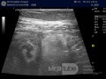 Abcès appendiculaire - L'échographie 2