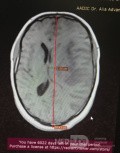 Craniectomie Décompressive