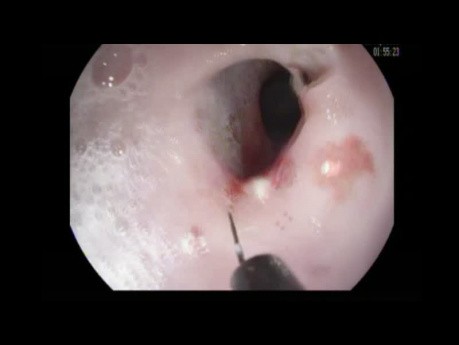 Traitement endoscopique d'un anneau de Schatzki