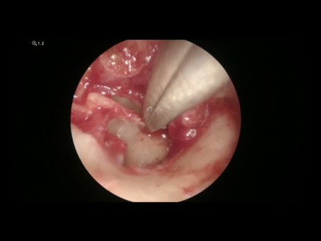 Tympanoplastie Endoscopique PORP pour Otite Séromuquese Moyenne Chronique