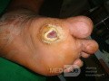 L'ulcère du pied diabétique avec l'ostéomyélite.