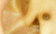 Nevus composé