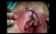 Chirurgie du cancer de la vulve - l'ablation et un double greffe