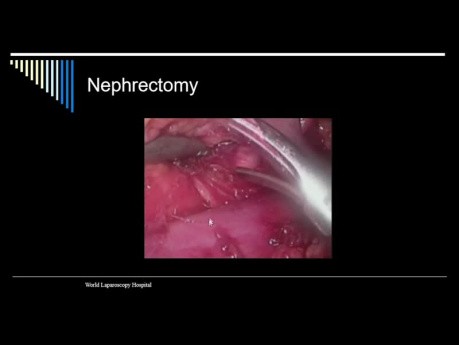 Néphrectomie par voie cœlioscopique