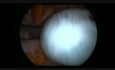 Torsion de l'annexe due aux kystes ovariens et paraovariens - prise en charge laparoscopique
