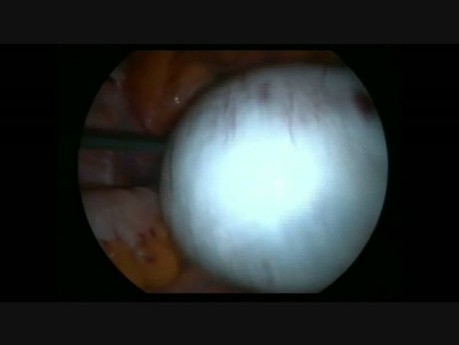 Torsion de l'annexe due aux kystes ovariens et paraovariens - prise en charge laparoscopique