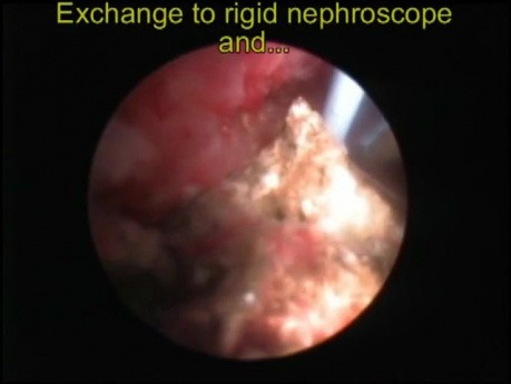 NLPC - Néphroscope souple