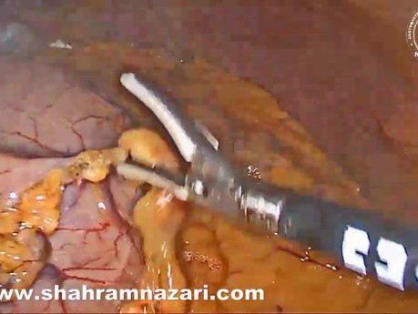 Résection Laparoscopique d'une Tumeur Stromale Gastro-Intestinale (GIST)