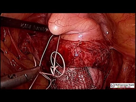 Sacrocolpopexie par voie laparoscopique pour le prolapsus de la voûte vaginale
