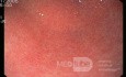 La gastrite chronique - vue endoscopique.