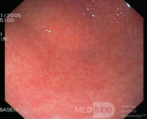 La gastrite chronique - vue endoscopique.