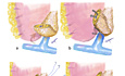 Technique simplifiée de pancreaticogastrostomie